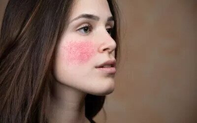 Wondering How to Treat Rosacea?