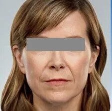 jupiter dermal fillers patient before