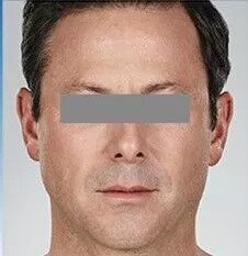 jupiter dermal fillers patient after