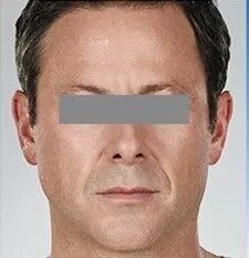 jupiter dermal fillers patient before