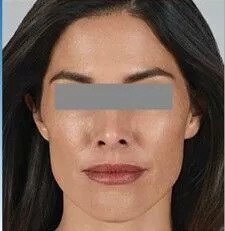 jupiter dermal fillers patient after