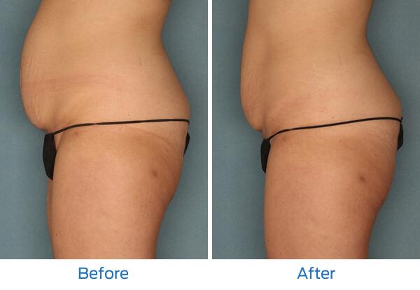 Velashape III Before & After Image