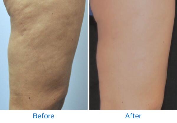 Velashape III Before & After Image