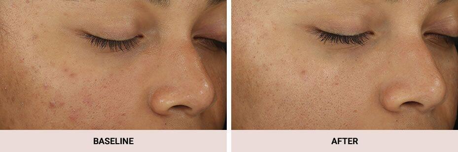 Diamondglow Dermalinfusion Before & After Image