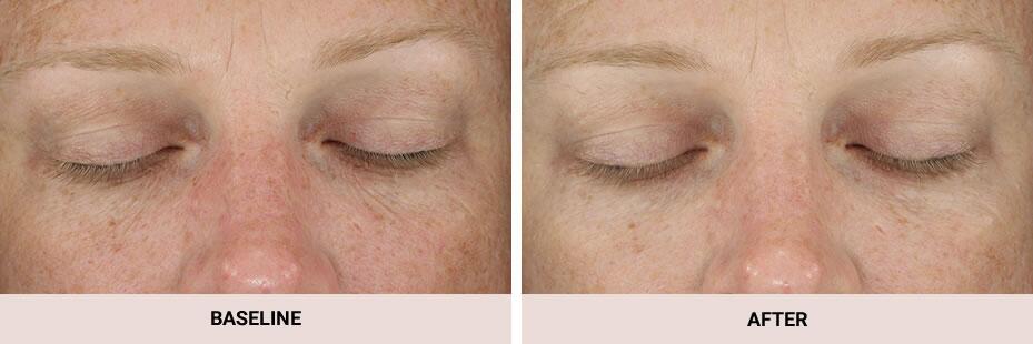 Diamondglow Dermalinfusion Before & After Image