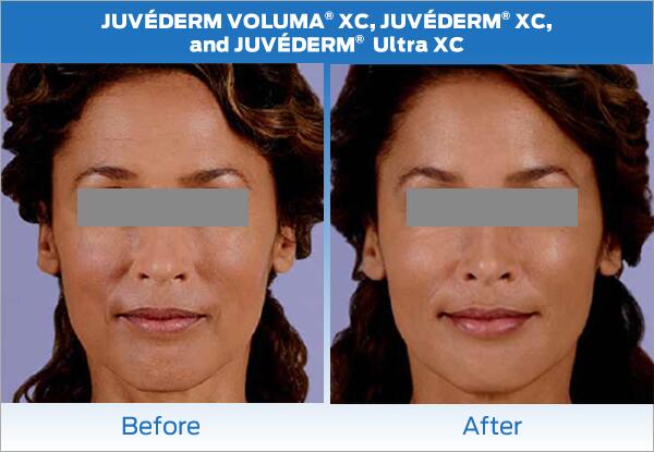 Dermal Fillers Before & After Image