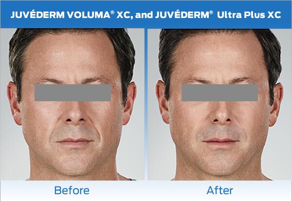 Dermal Fillers Before & After Image