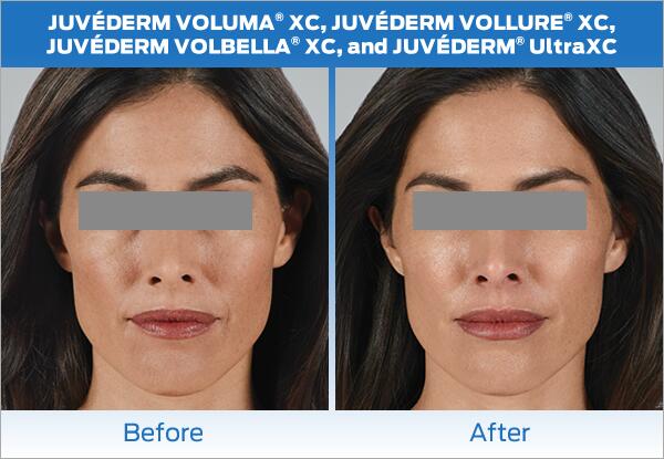 Dermal Fillers Before & After Image