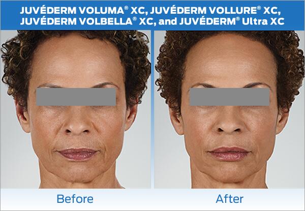 Dermal Fillers Before & After Image