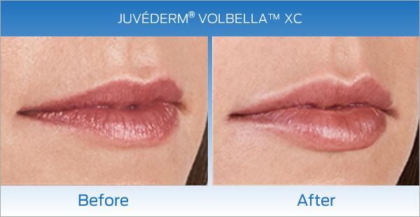 Lip Fillers Before & After Image