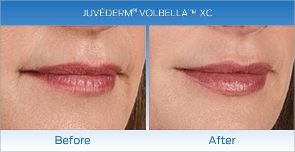 Lip Enhancement Before & After Image