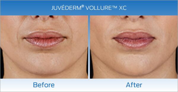Lip Enhancement Before & After Image