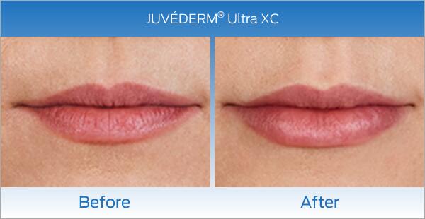 Lip Fillers Before & After Image