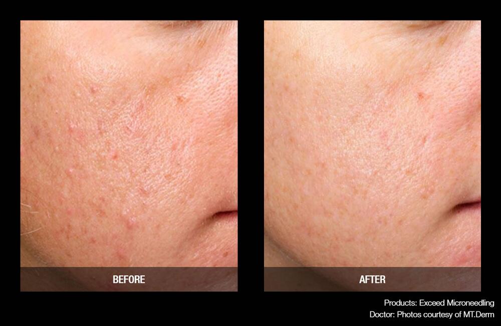 Medical Microneedling Before & After Image