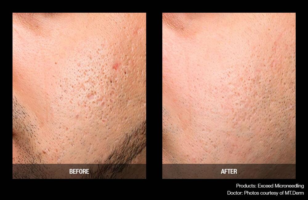 Medical Microneedling Before & After Image