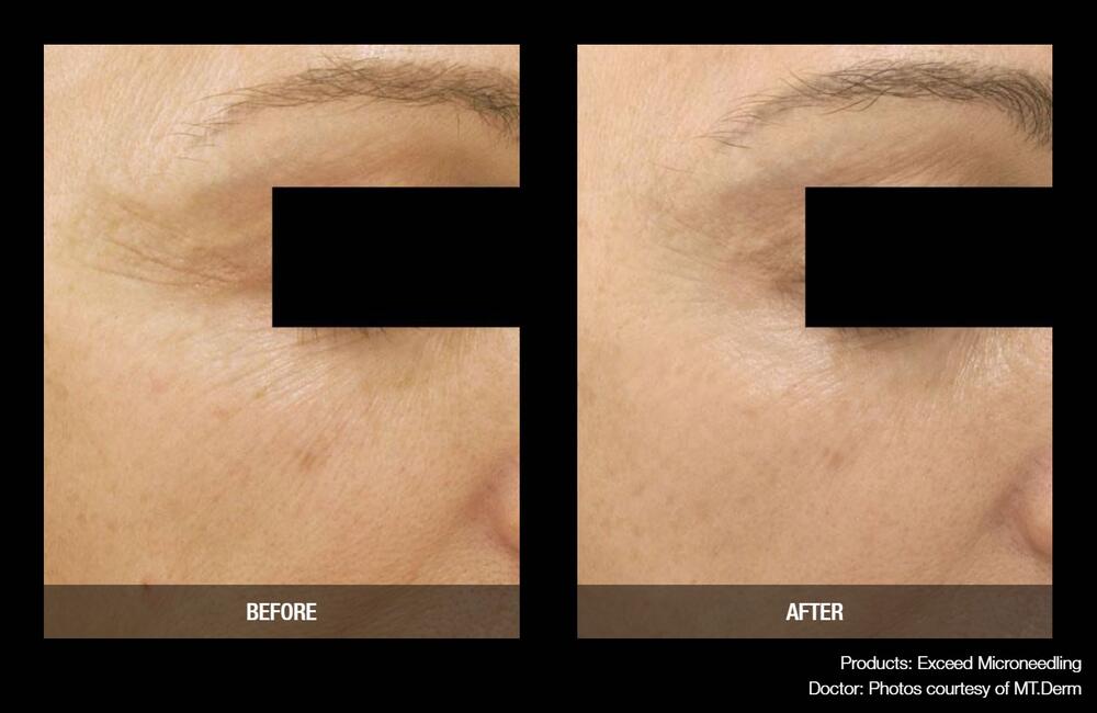 Medical Microneedling Before & After Image
