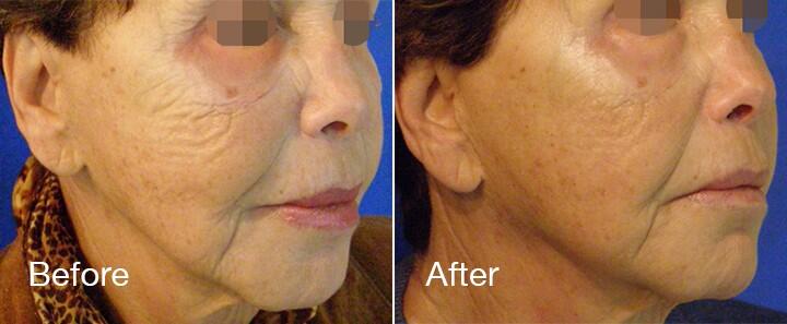 RF Microneedling Before & After Image