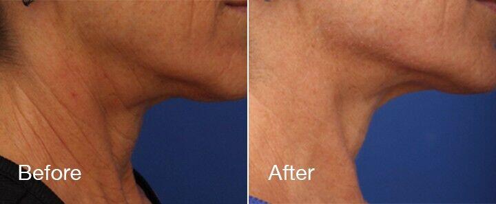 RF Microneedling Before & After Image