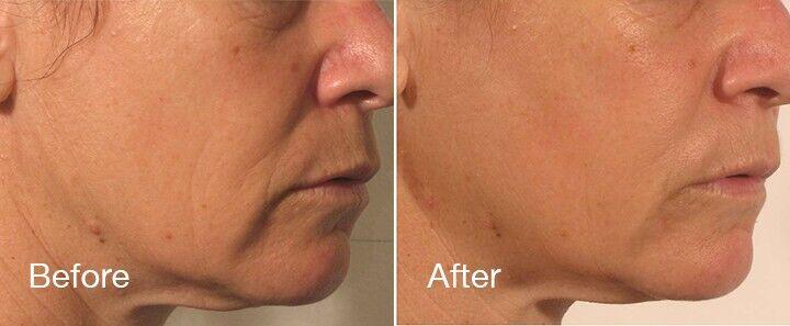 RF Microneedling Before & After Image