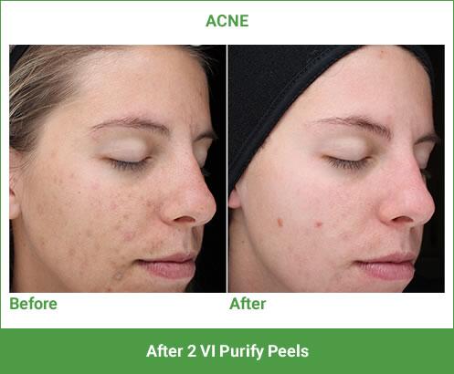 VI Peel Before & After Image