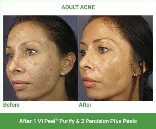 VI Peel Before & After Image