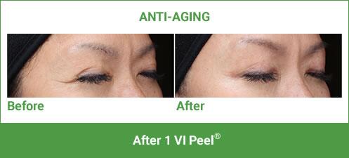 VI Peel Before & After Image