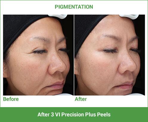 VI Peel Before & After Image