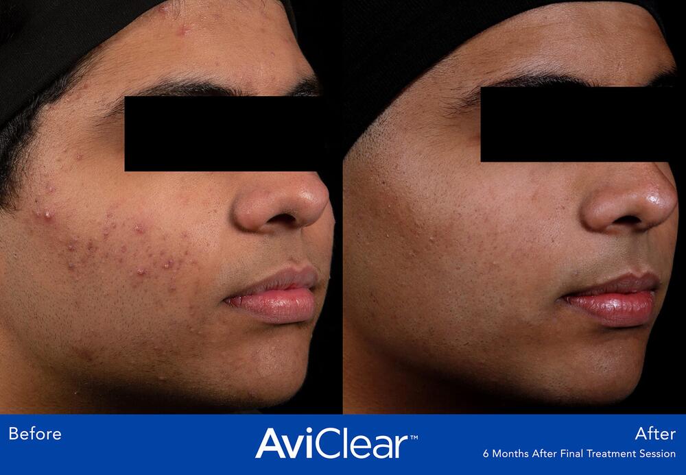 AviClear Laser For Acne Before & After Image