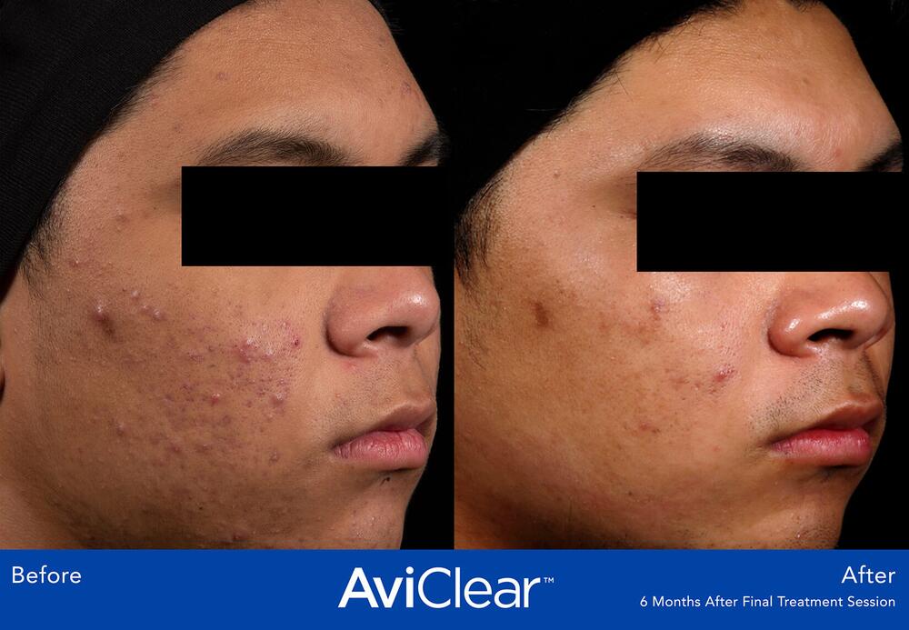 AviClear Laser For Acne Before & After Image