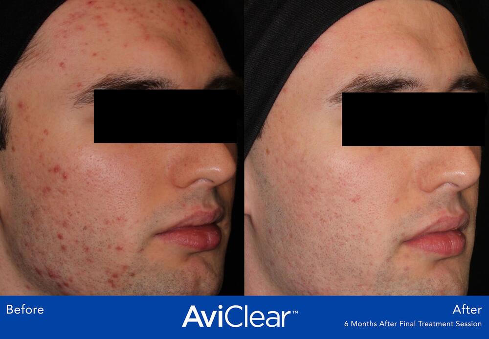 AviClear Laser For Acne Before & After Image