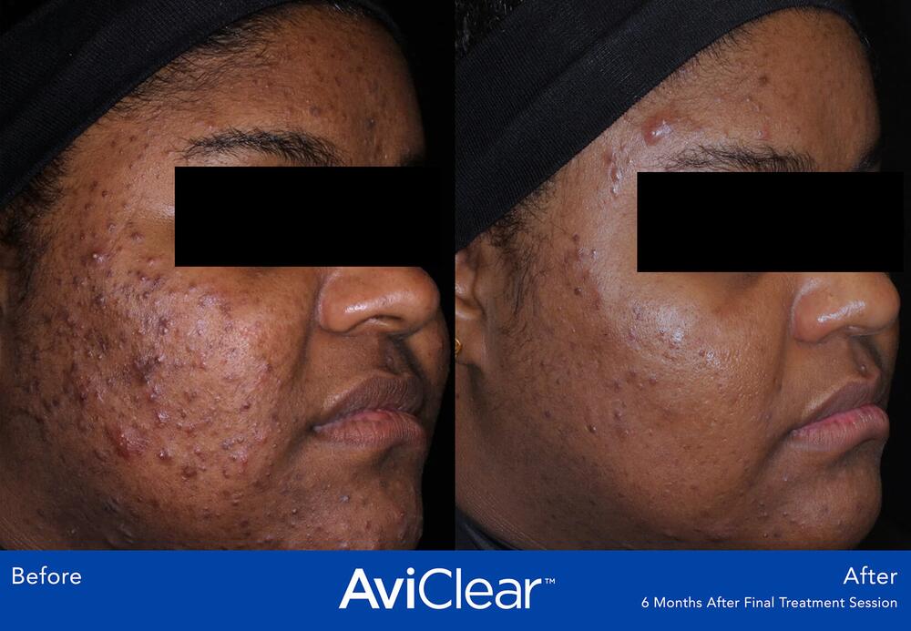 AviClear Laser For Acne Before & After Image