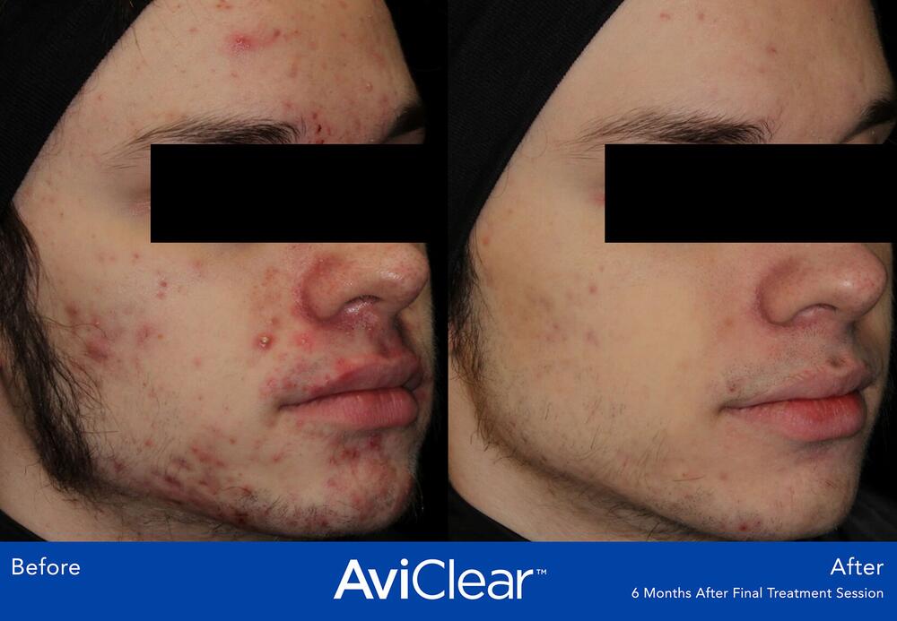 AviClear Laser For Acne Before & After Image