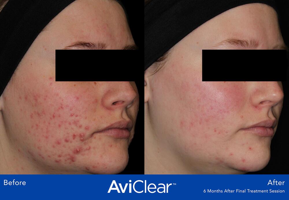 AviClear Laser For Acne Before & After Image