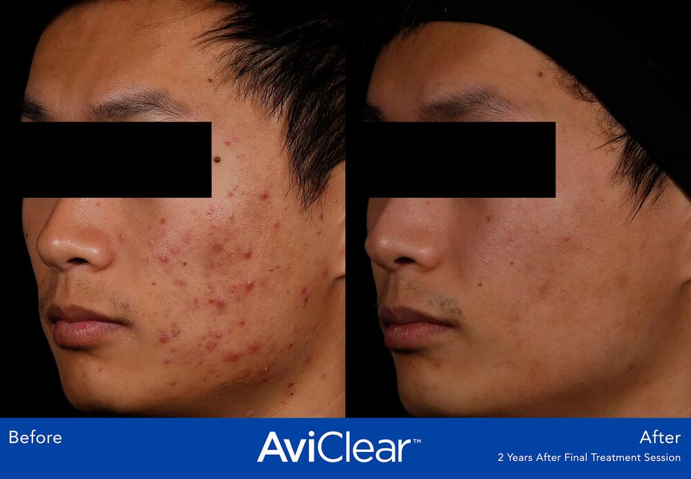 AviClear Laser For Acne Before & After Image