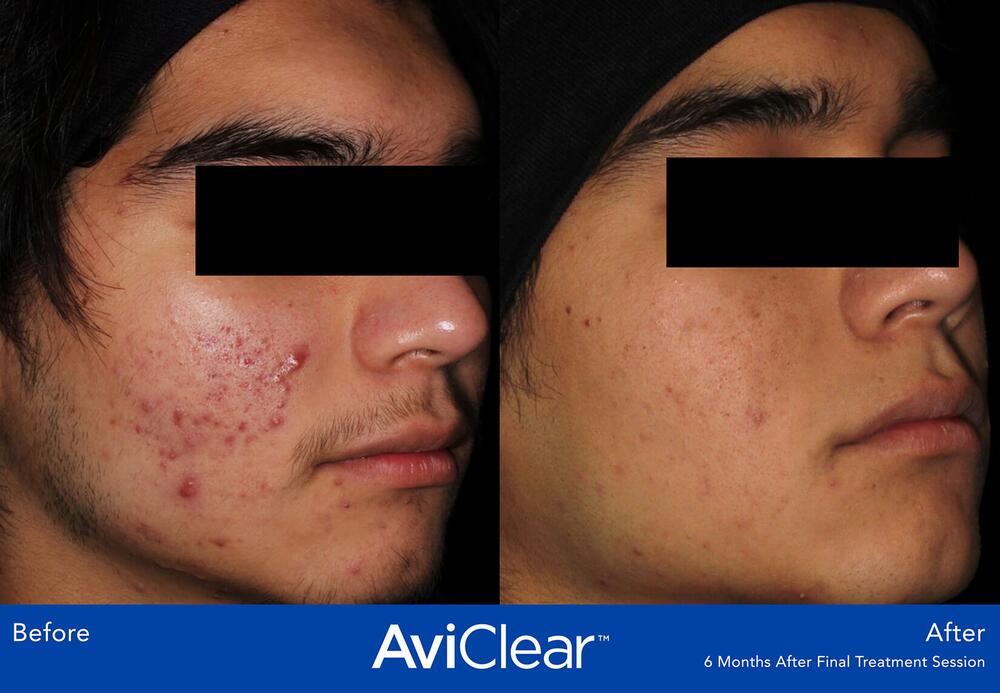 AviClear Laser For Acne Before & After Image