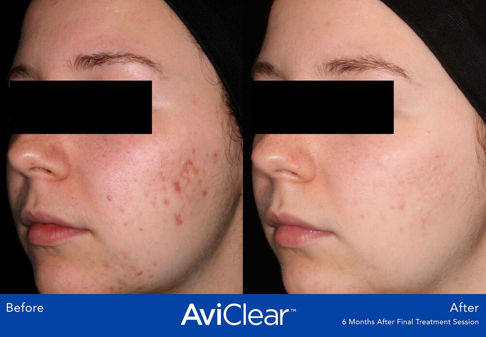 AviClear Laser For Acne Before & After Image