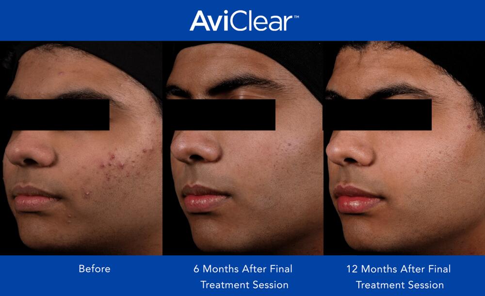 AviClear Laser For Acne Before & After Image