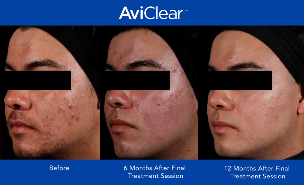 AviClear Laser For Acne Before & After Image