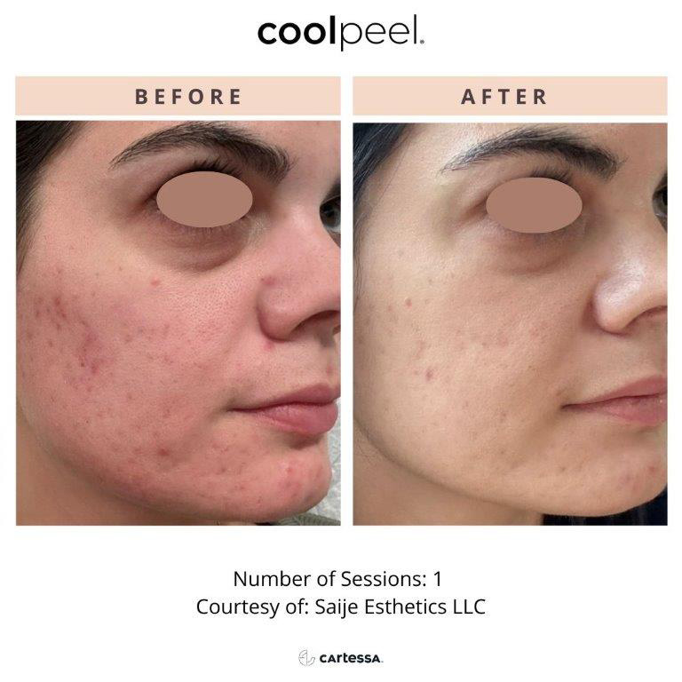CoolPeel Before & After Image