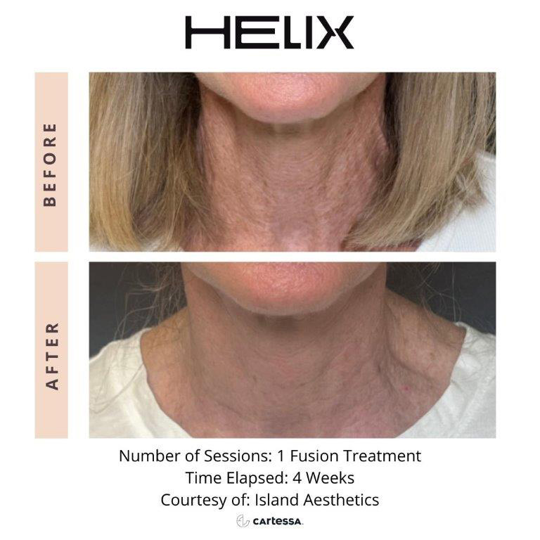 CoolPeel Before & After Image