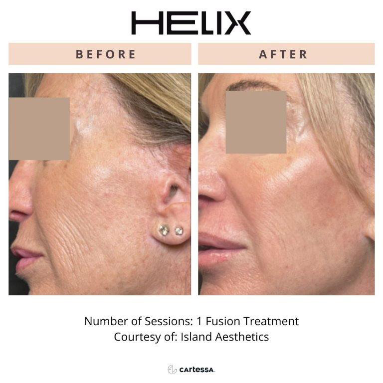 CoolPeel Before & After Image