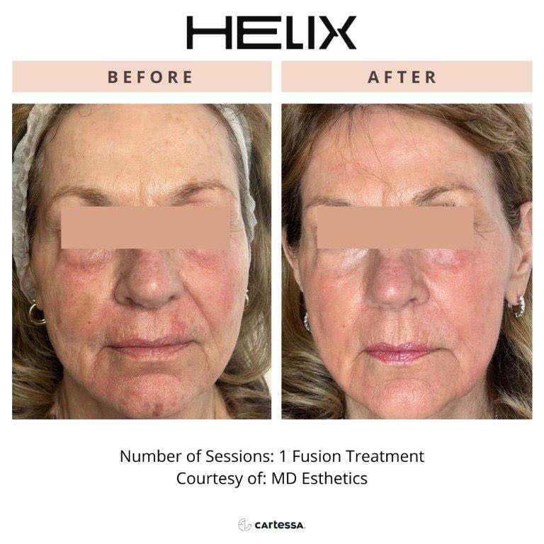 CoolPeel Before & After Image