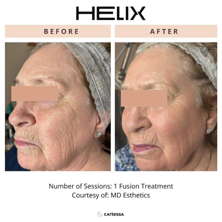 CoolPeel Before & After Image