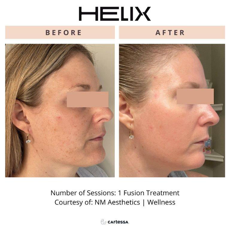 CoolPeel Before & After Image