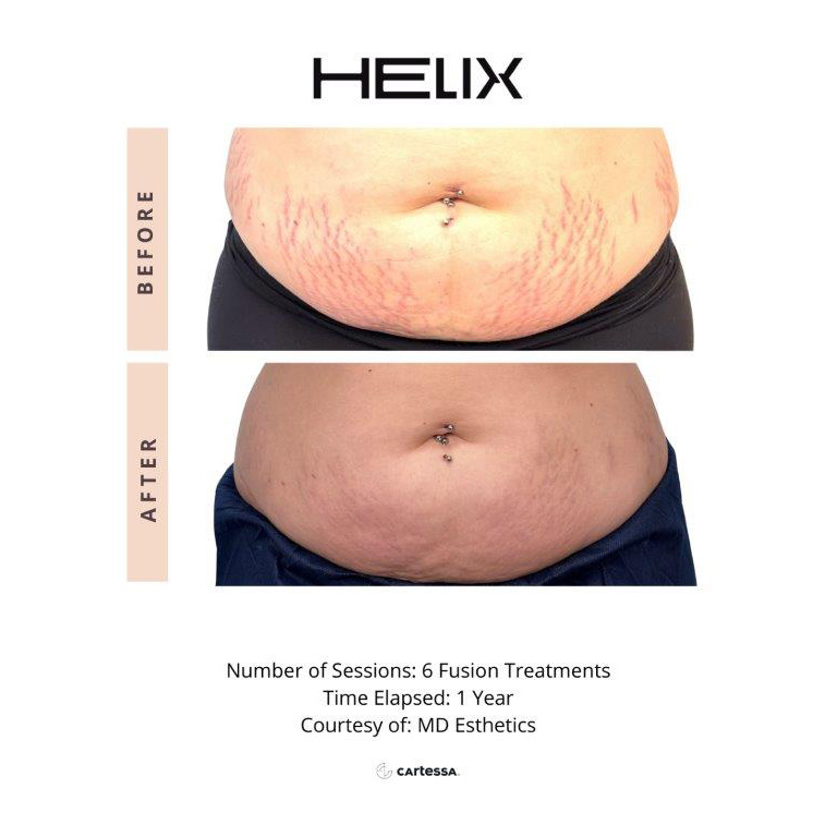 CoolPeel Before & After Image