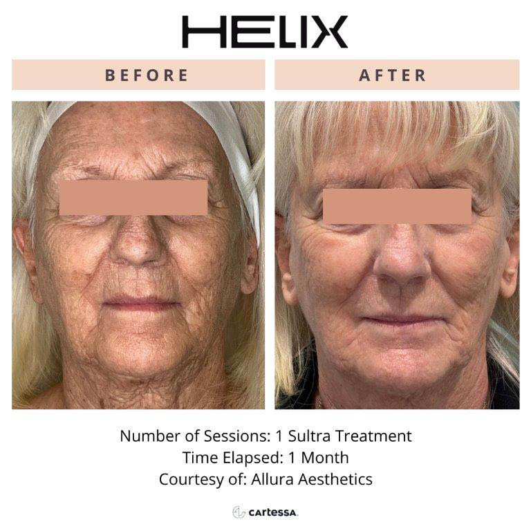 CoolPeel Before & After Image