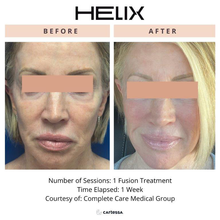 CoolPeel Before & After Image