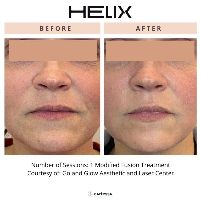 CoolPeel Before & After Image