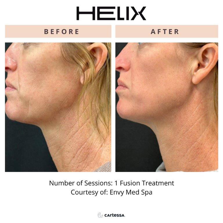 CoolPeel Before & After Image