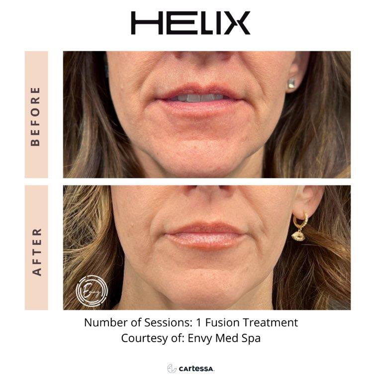 CoolPeel Before & After Image